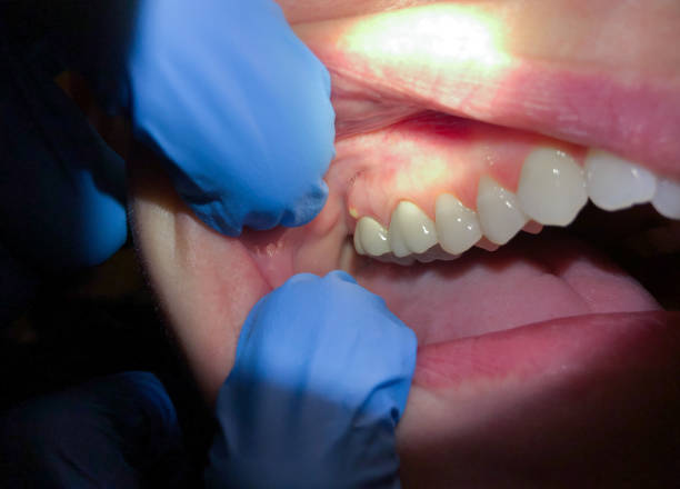 Best Emergency Tooth Extraction in Sugarland Run, VA